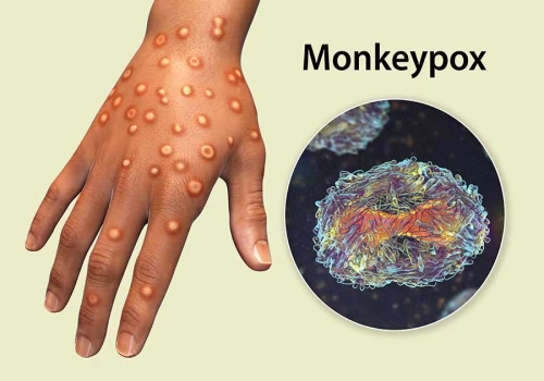 India tightens Mpox surveillance as global cases surge; suspected case in PoK raises concerns