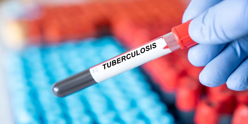 Union Health Ministry approves new, shorter treatment for drug-resistant TB Union Health Ministry approves new, shorter treatment for drug-resistant TB